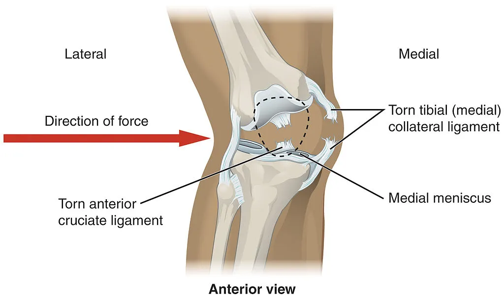 Diagram of the knee showing torn anterior cruciate and medial collateral ligaments and the meniscus