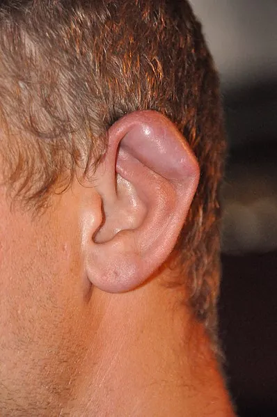 Close-up of a swollen, misshapen cauliflower ear