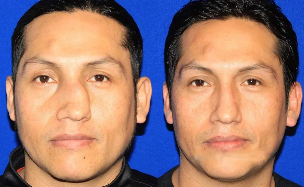 Before and after photos of a man's face showing a healed broken nose