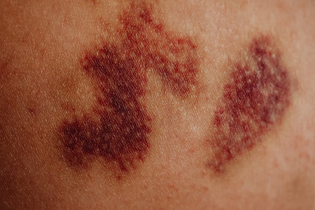 Close-up of dark purple bruises on skin