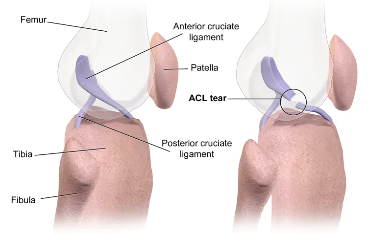 Diagram of the knee joint with an ACL tear circled, labelling the femur, tibia, patella and ligaments