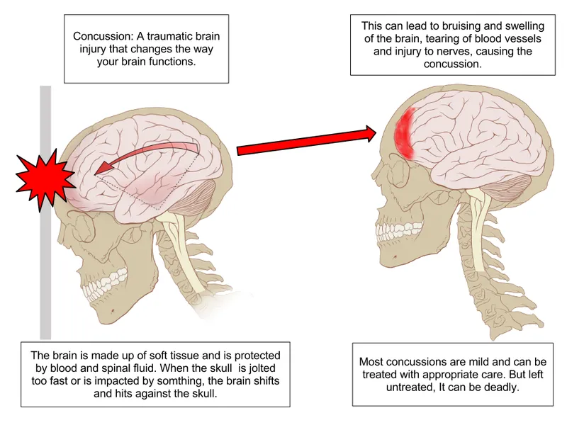 Diagram showing how a concussion happens when the brain shifts and strikes the inside of the skull