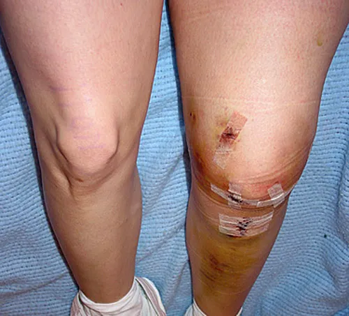Close-up of a bruised knee with dressings and surgical tape after an operation