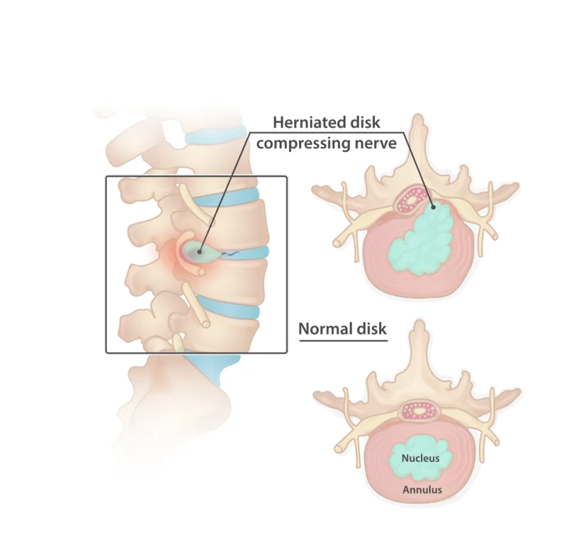 Diagram comparing a herniated spinal disc pressing on a nerve with a normal disc