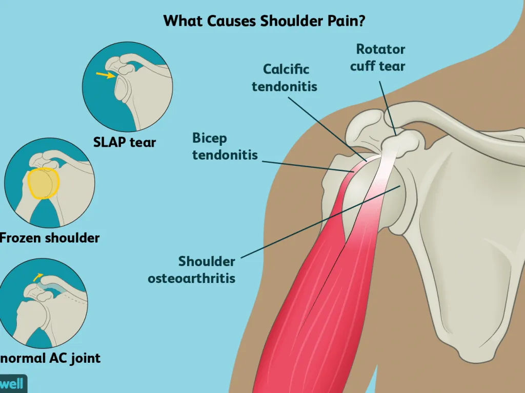 Diagram of common shoulder injuries including rotator cuff tear, SLAP tear and frozen shoulder